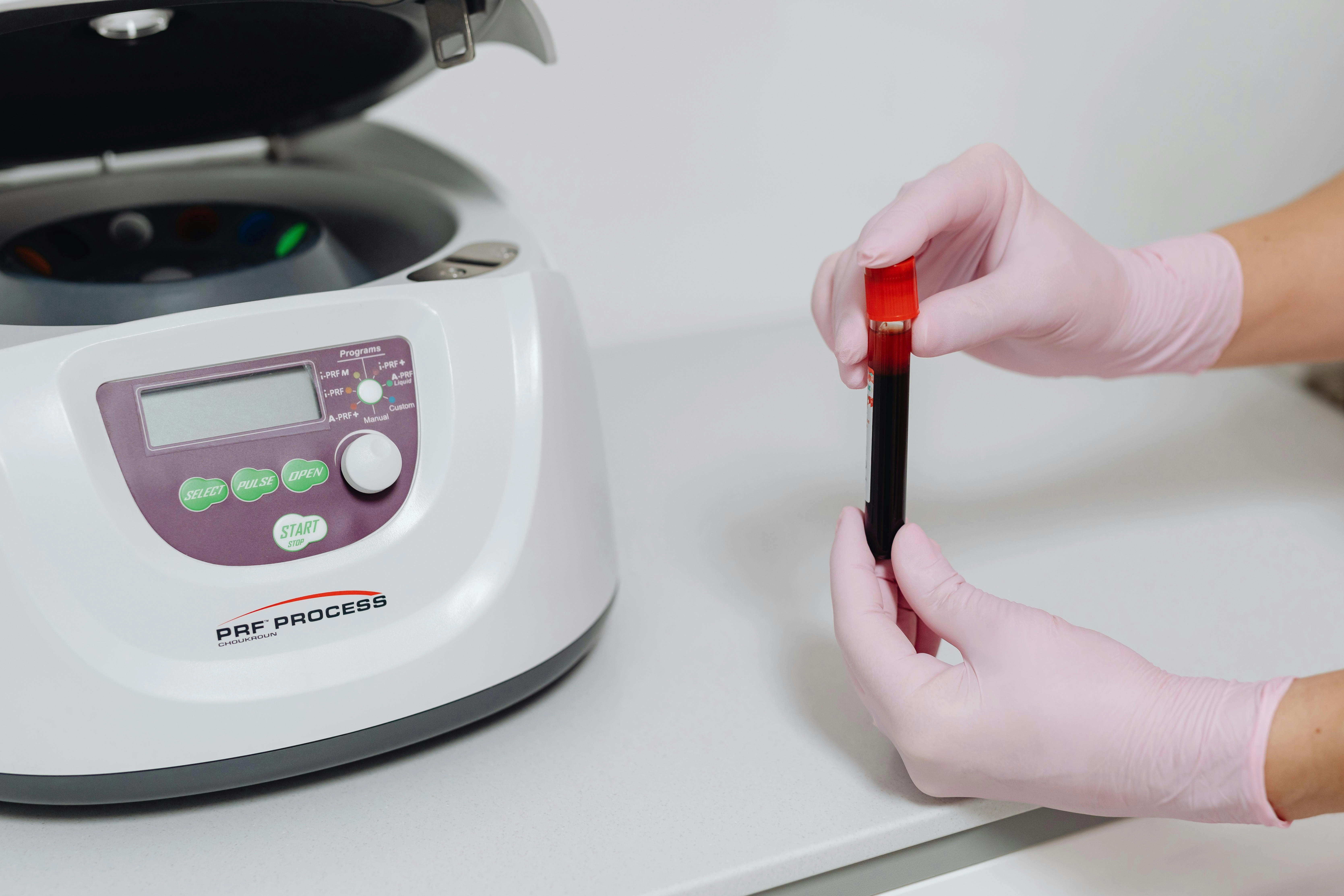 PRF Process Blood Analysis